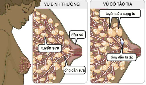 Tắc tia sữa là tia sữa bị ứ lại ở ống dẫn sữa làm cho sữa không chảy ra ngoài được