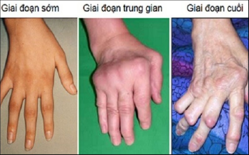 Triệu chứng bệnh viêm khớp dạng thấp qua từng giai đoạn