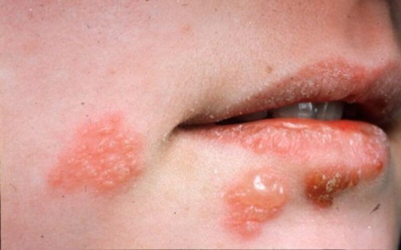 Các bệnh do virus Herpes gây ra