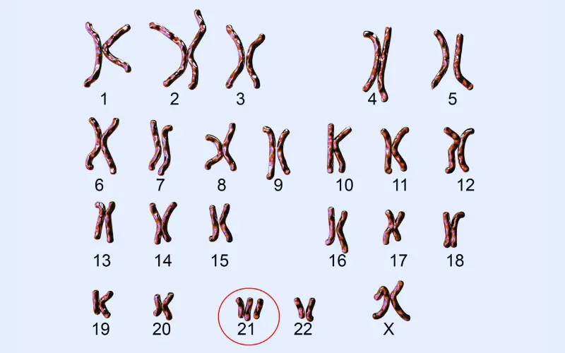 Hội chứng Down xảy ra khi một người có 3 nhiễm sắc thể thứ 21