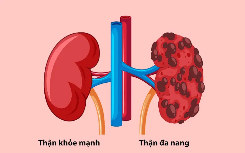 Bệnh nhân mắc bệnh thận đa nang thường có nguy cơ suy thận cao